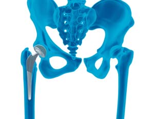 Outpatient Hip Replacement