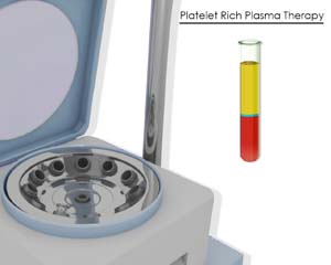 Platelet – Rich Plasma
