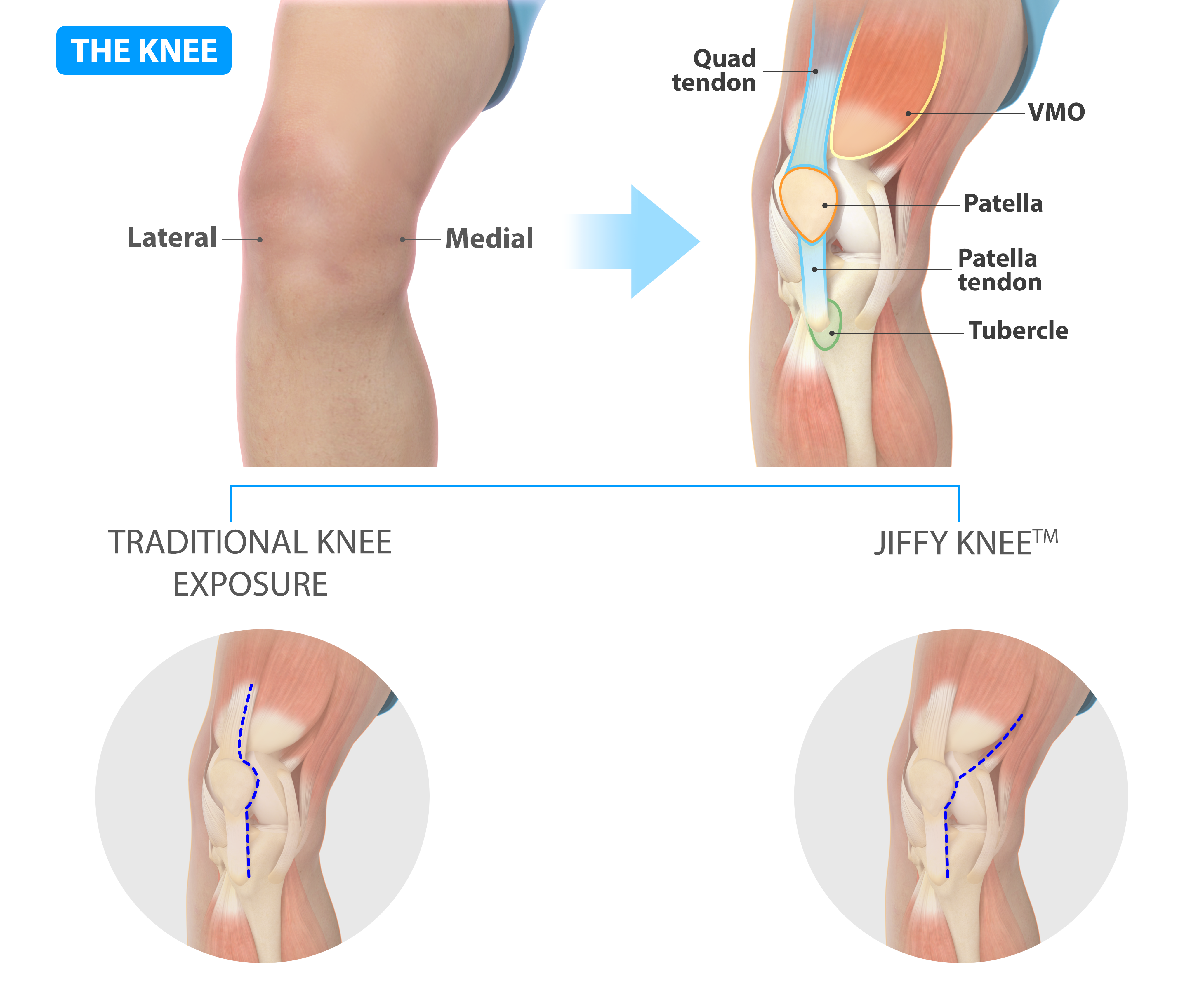 Jiffy Knee™ Joint Replacement
